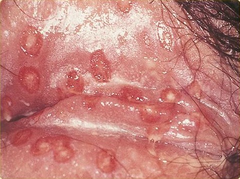 SOA Herpes genitalis female